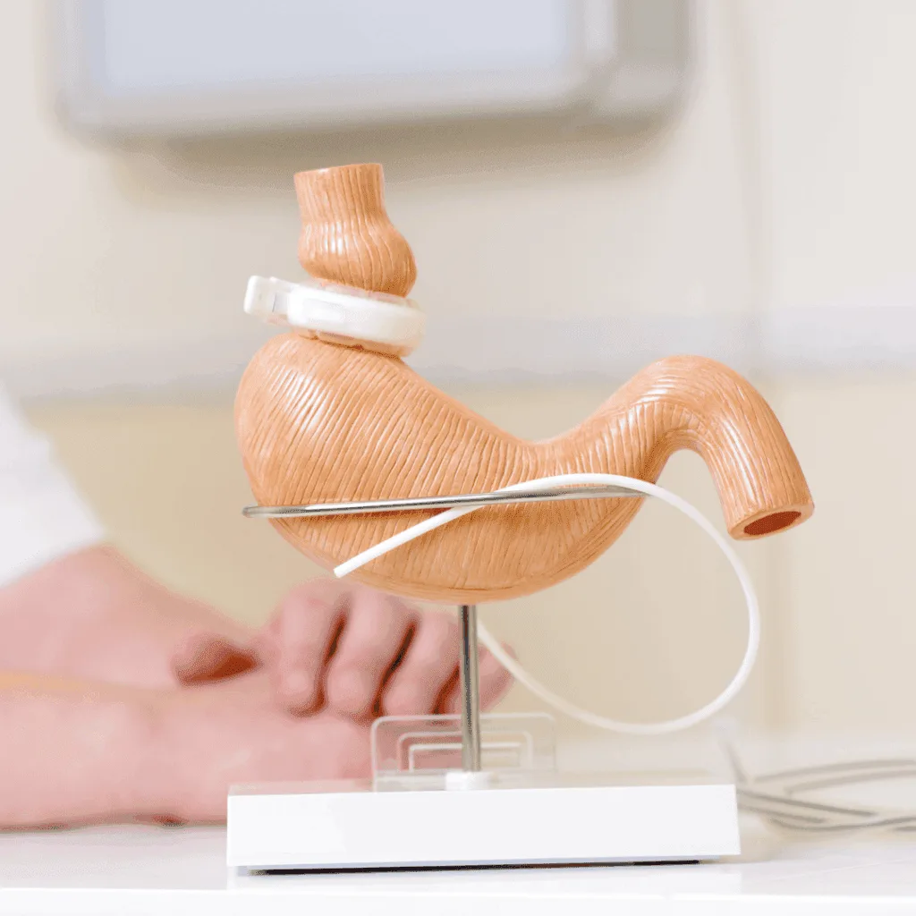 Model of a stomach with a gastric band, representing bariatric surgery